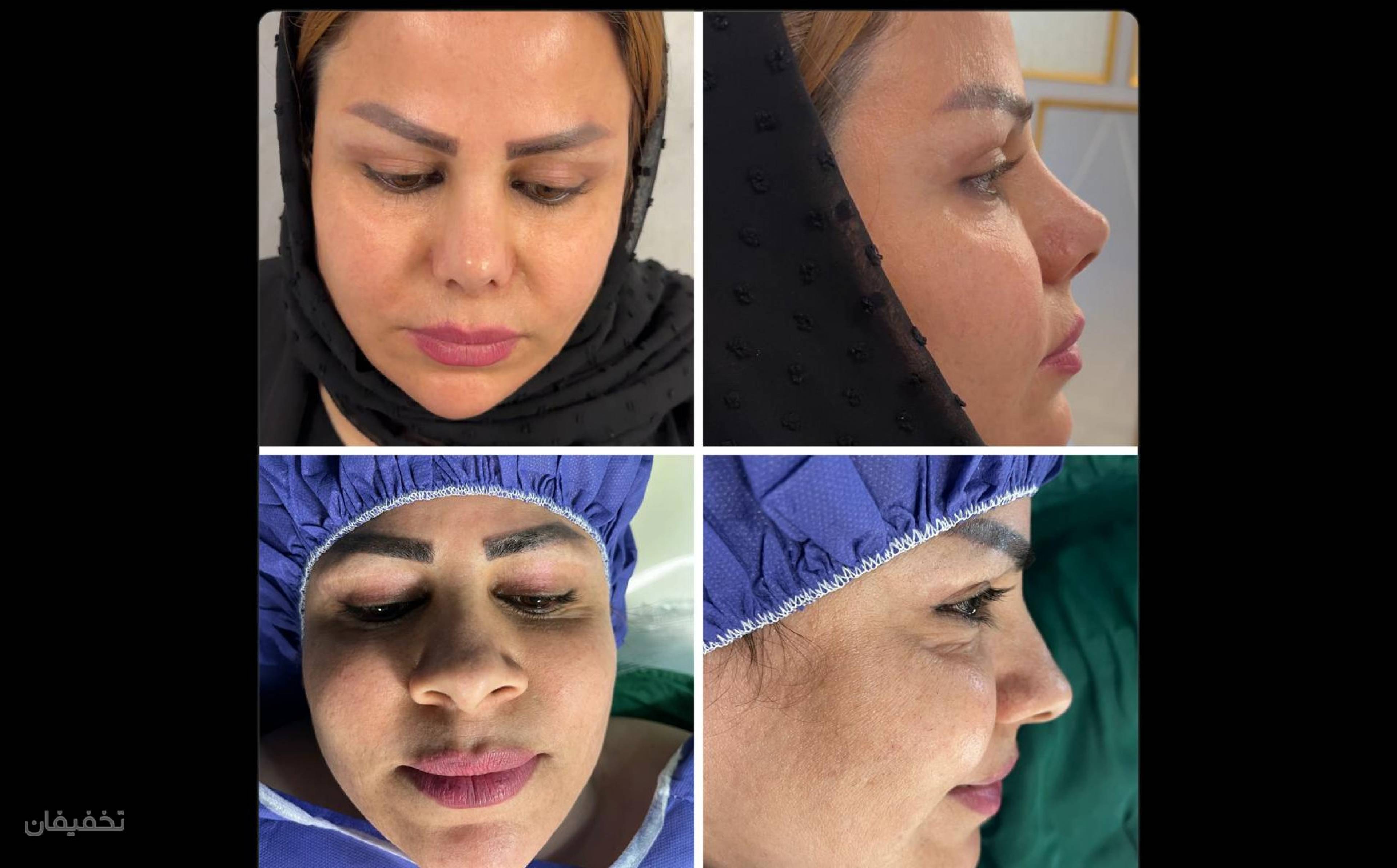 جراحی بینی