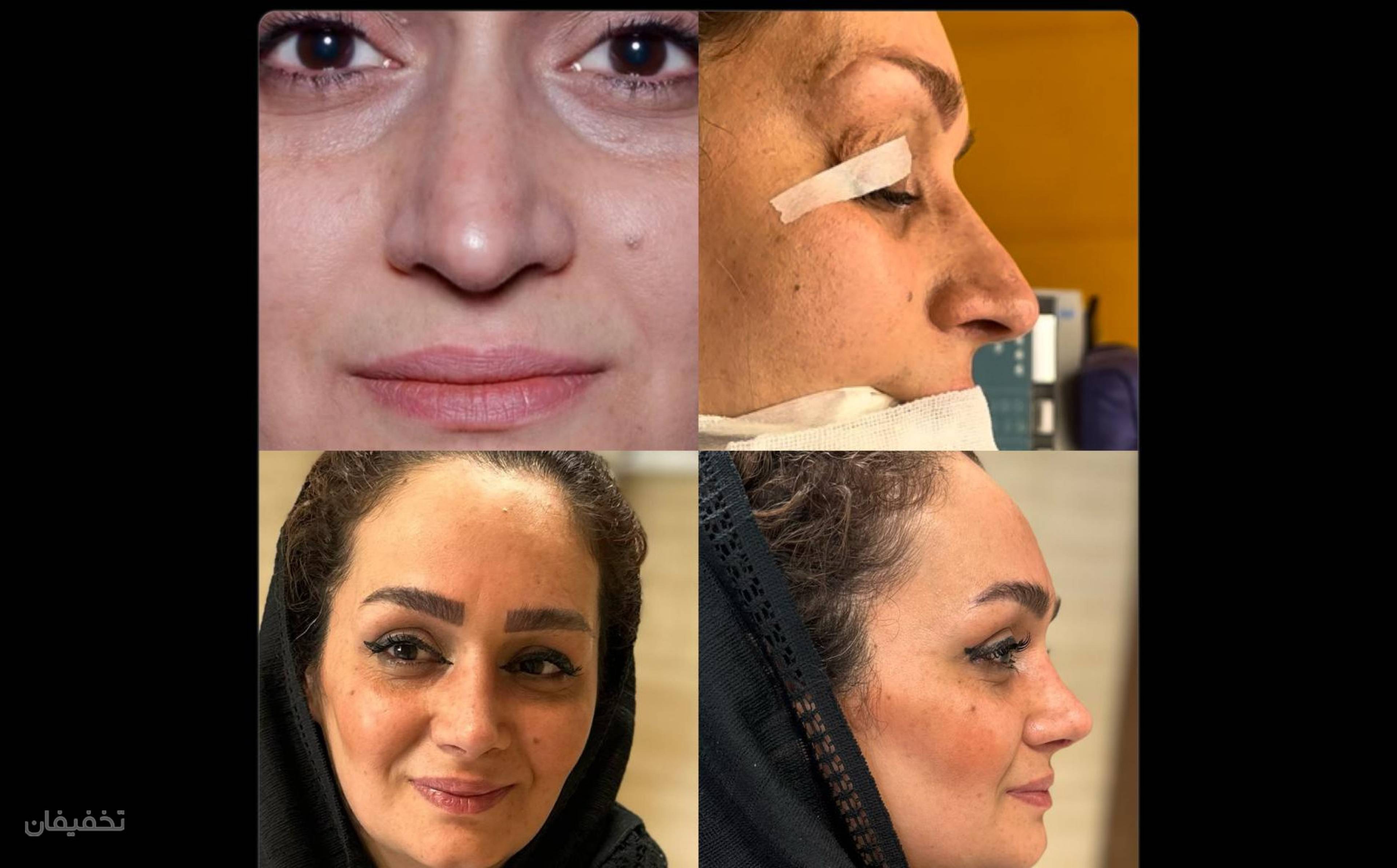 جراحی بینی