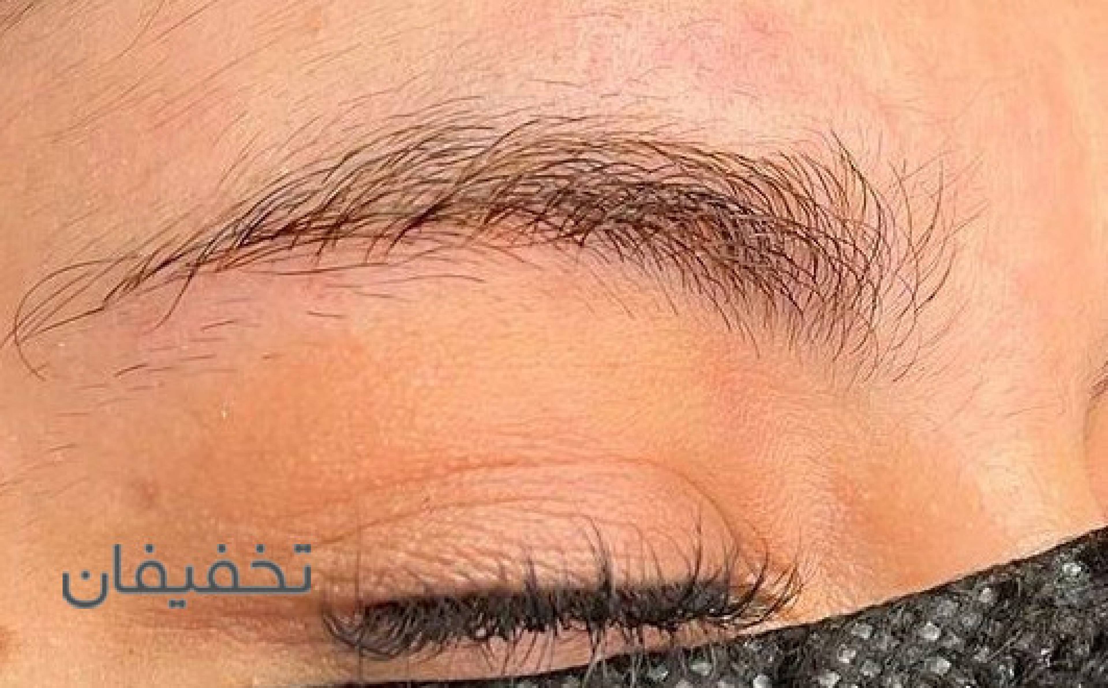 فیبروز و میکروبلیدینگ مهشید