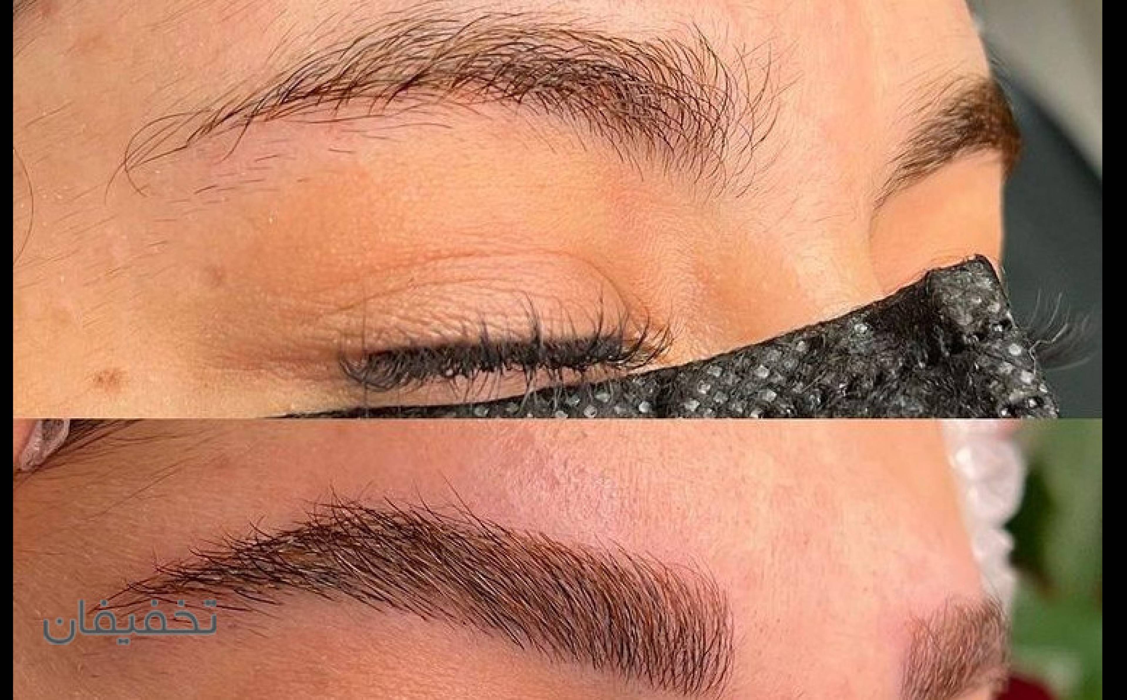 فیبروز و میکروبلیدینگ مهشید
