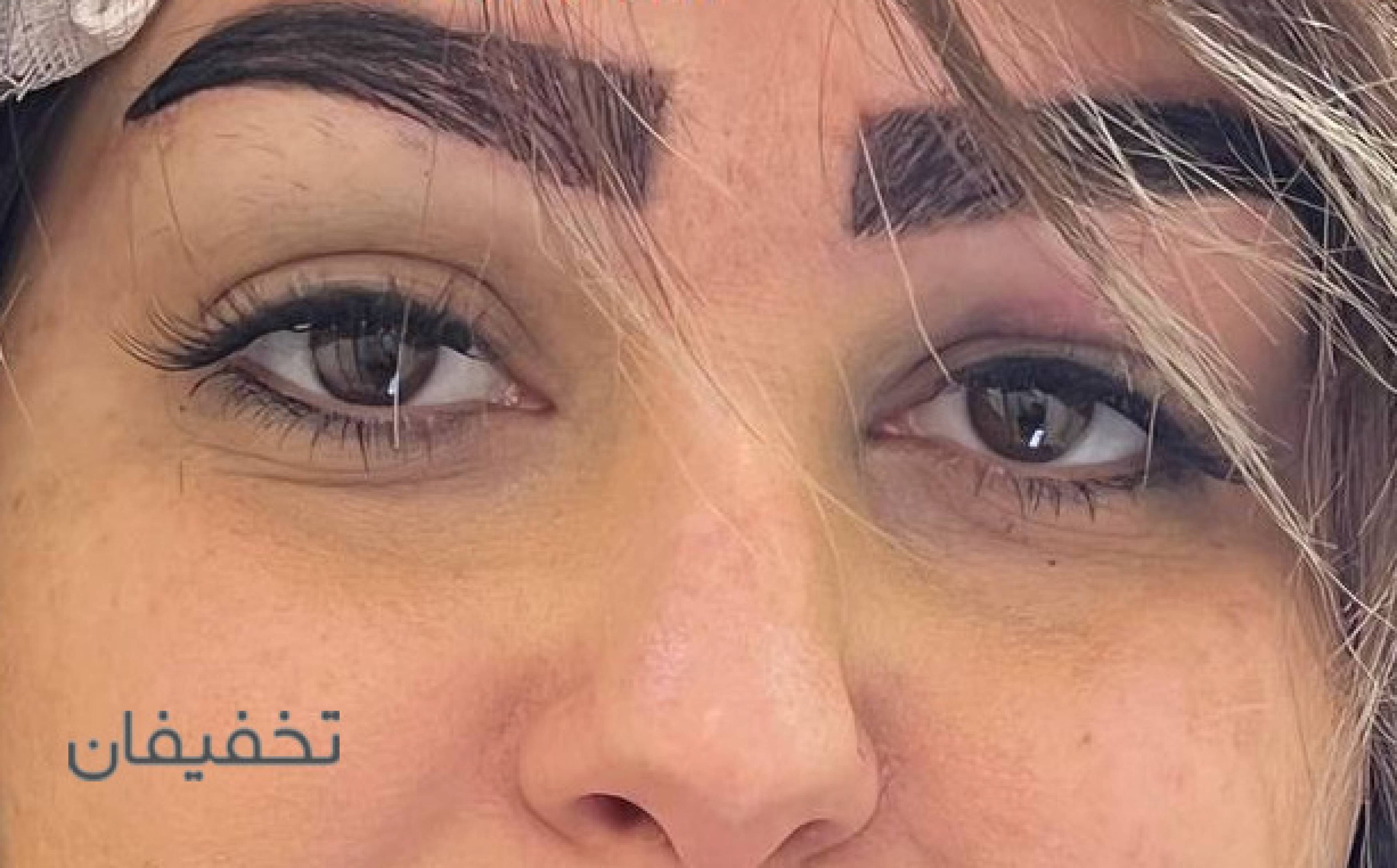 کاشت ابرو مرجان کسرایی