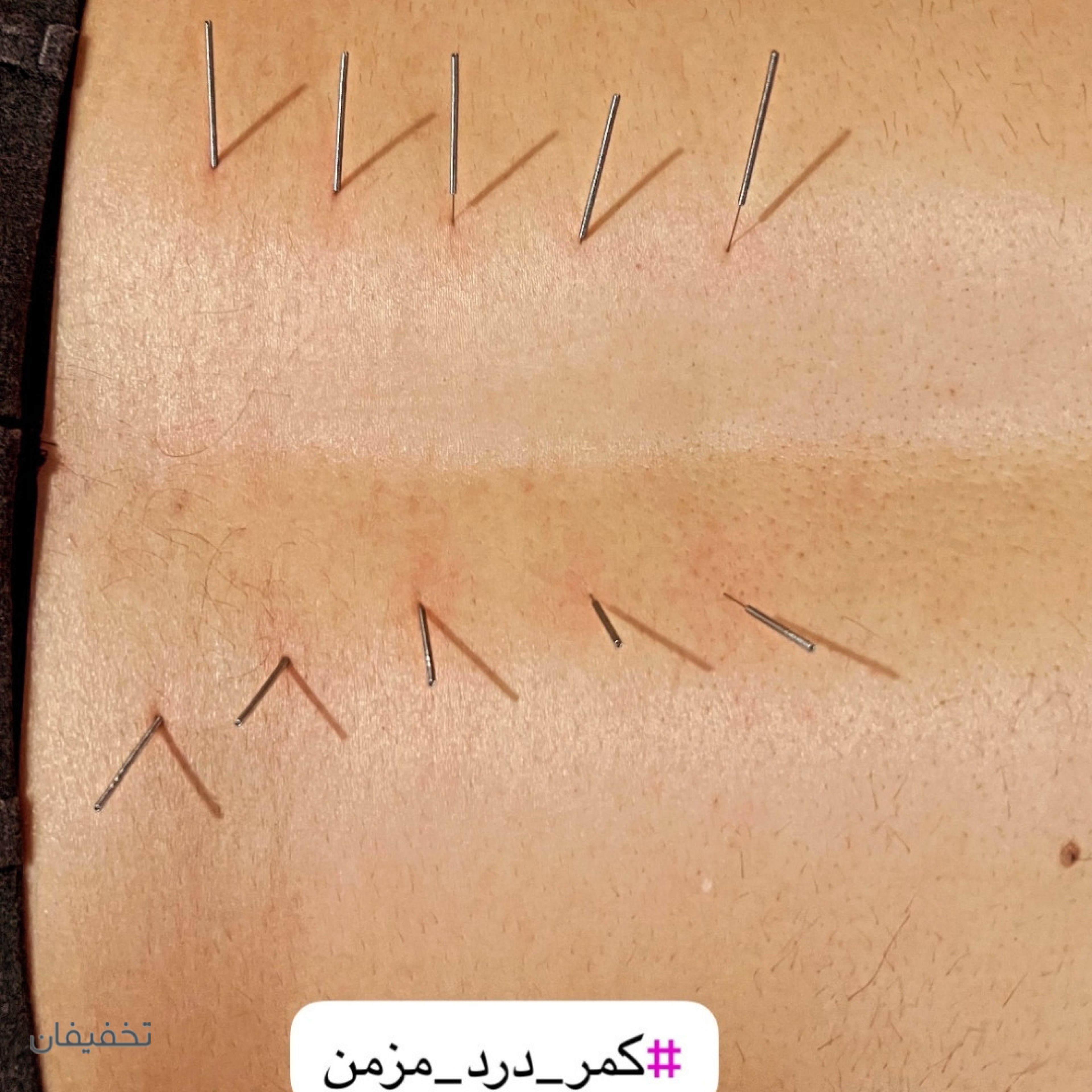 فیزیوتراپی نوشین مهر