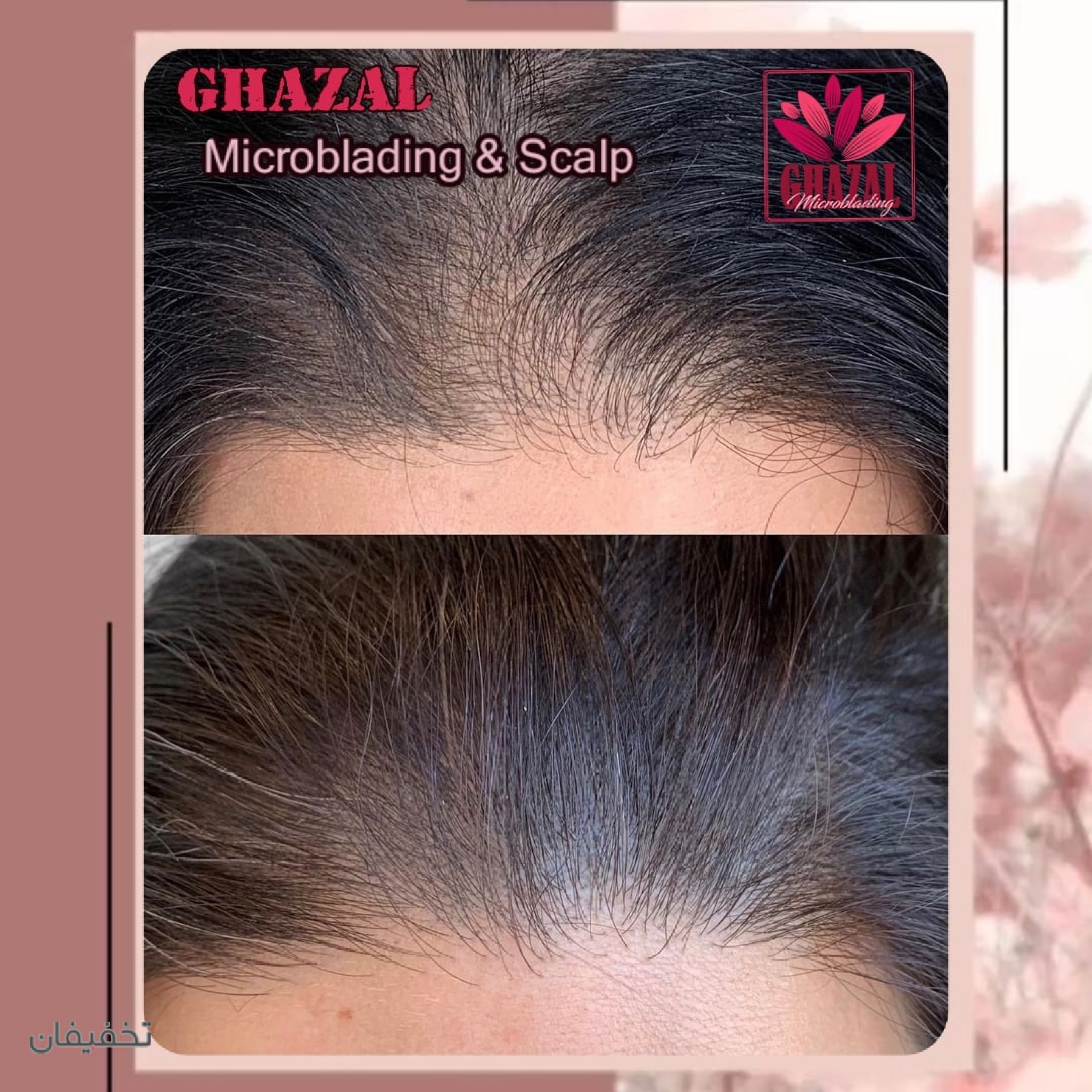 میکروبلیدینگ و شیدینگ لب غزل